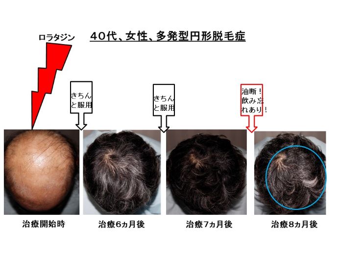 円形脱毛症　病院